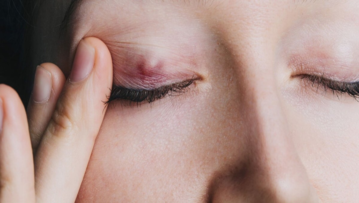 Small Lumps on Eyelids: What is Chalazion and How to Keep Your Eyes Healthy